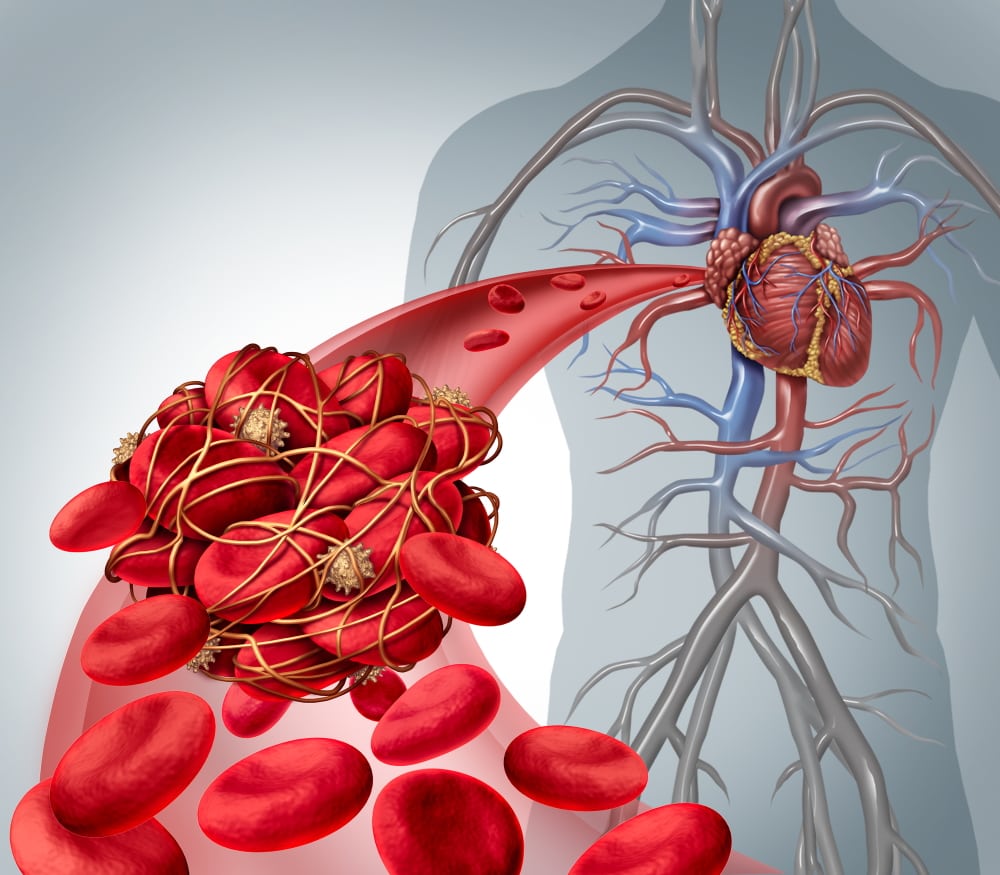 Grafik mit Blutgerinnsel mit menschlichem Körper mit Gefäßen im Hintergrund